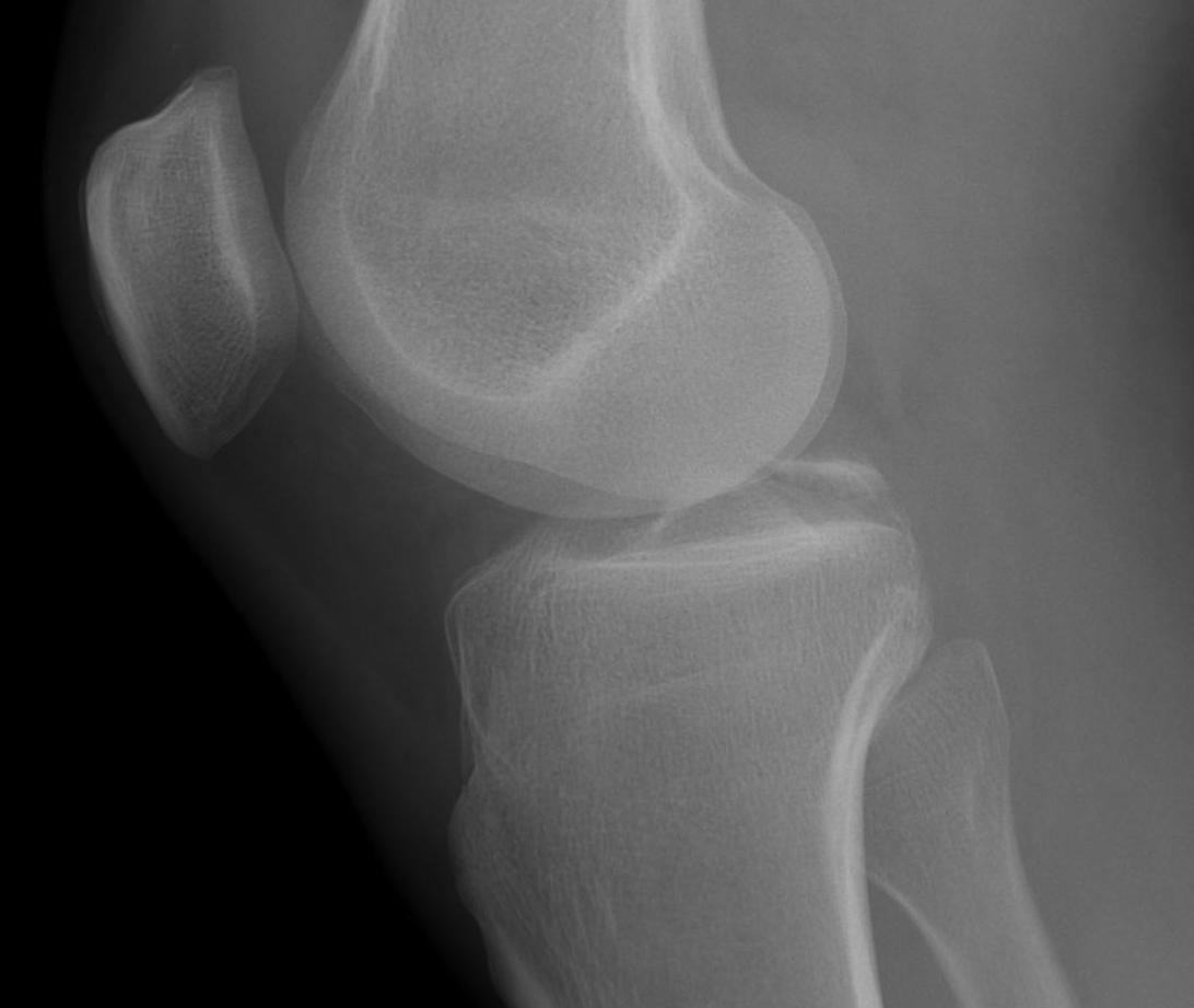 PCL bony avulsion